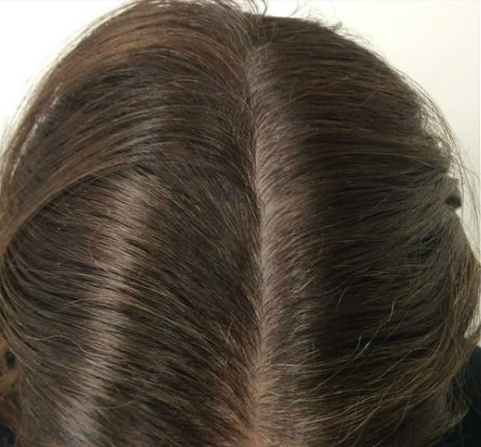 After Treatment - Bee Choo Origin Malaysia