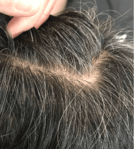 White Hair Before Treatment - Bee Choo Origin Malaysia