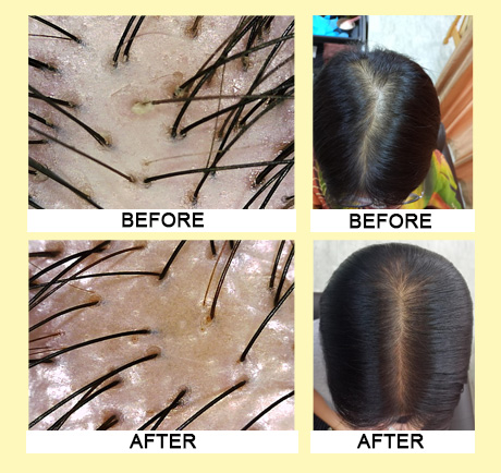 Testimonials Hair Loss Treatment - Bee Choo Origin Malaysia